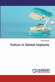 Failure in Dental Implants, Kumar Prince