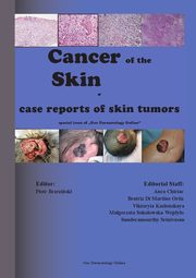 ksiazka tytu: Cancer of the Skin - case reports of skin tumors autor: Piotr Brzezinski