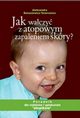 Jak walczy z atopowym zapaleniem skry, Aleksandra Banasiewicz-Tenerowicz